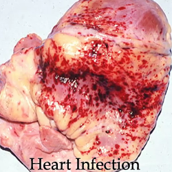 heart infection